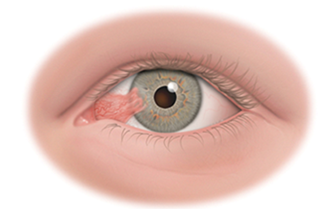 remover carnosidad ocular puerto vallarta